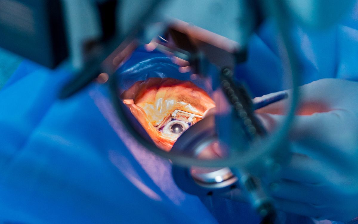 Cataracte tout savoir sur cette pathologie et son traitement — free download